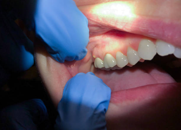 Best Emergency Dentist for Lost Fillings or Crowns in Signal Mountain, TN